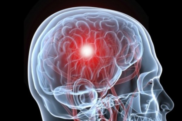Тархины цус харвалтын дараах сэргээн засах эмчилгээнд аль физик эмчилгээний төрөл чухал ач холбогдолтой вэ